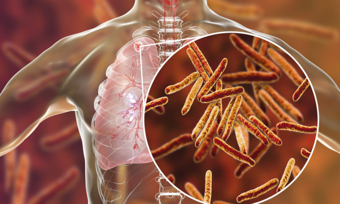 Συναγερμός από τους επιστήμονες για τη φυματίωση - Αυξάνονται τα κρούσματα σε όλον τον κόσμο