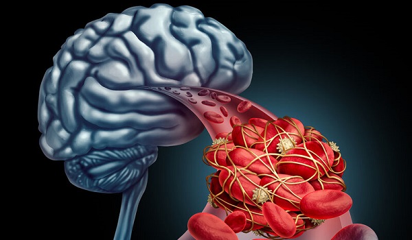 Εγκεφαλικό ανεύρυσμα: Ο ρόλος της ασπιρίνης στην εξέλιξή του