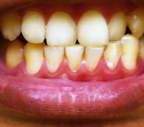 Προσοχή: Τι αποκαλύπτει η ουλίτιδα για την καρδιά σας – Η σύνδεση «σοκ» με εγκεφαλικά και εμφράγματα