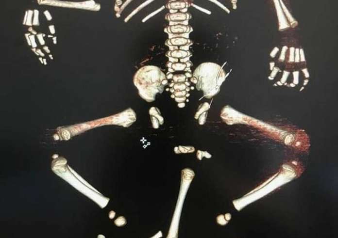 Αγοράκι γεννήθηκε με τρία πόδια και δύο ουρήθρες