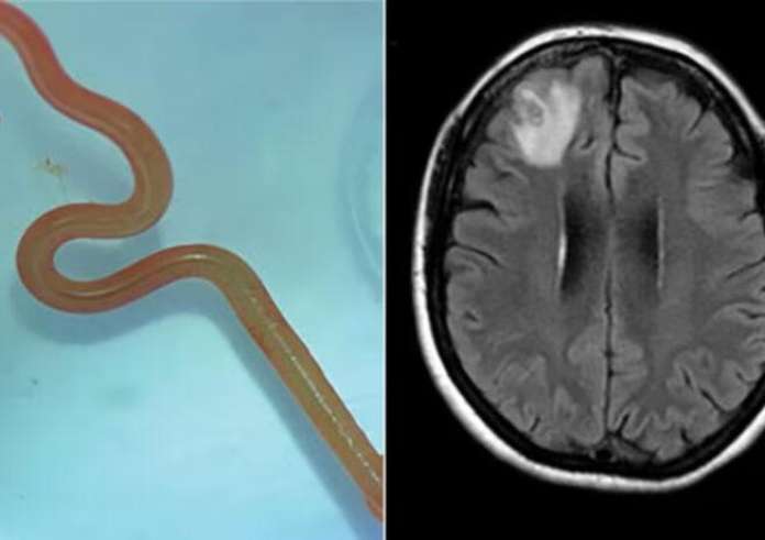 Αυστραλία: Ζωντανό σκουλήκι 8 εκατοστών βρέθηκε στον εγκέφαλο γυναίκας