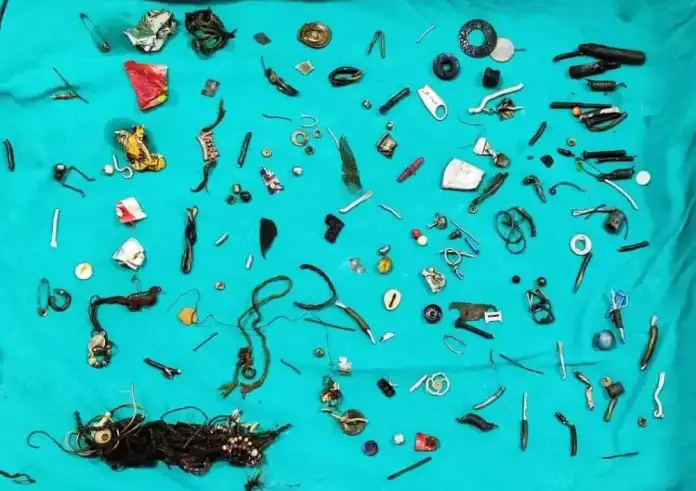 Πήγε στο νοσοκομείο με πόνο στο στομάχι: Άναυδοι οι γιατροί βρήκαν 60 οικιακά αντικείμενα στο έντερο του