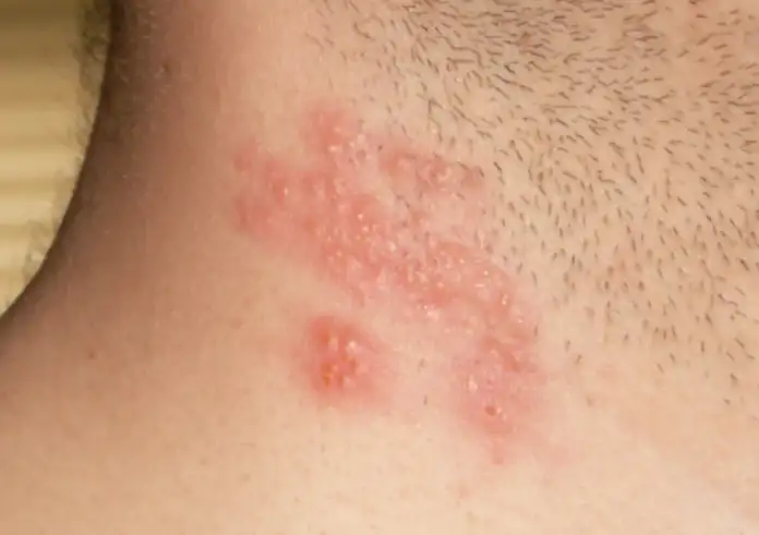 Έρπης: Προσοχή στα διαφορετικά είδη του ιού – Πρώτα συμπτώματα και επιπτώσεις