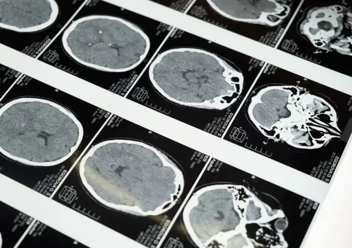 Μια παύση στην ομιλία μπορεί να πει πολλά: Πώς η επιβράδυνση του λόγου προειδοποιεί για γνωστική έκπτωση