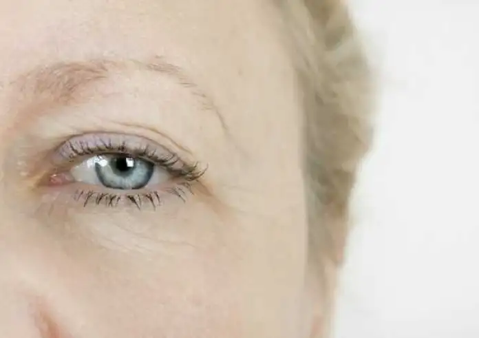 Bλεφαρόπτωση: Τι την προκαλεί και πώς αντιμετωπίζεται