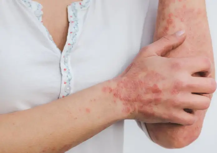 Αυτοάνοσα νοσήματα: Τα προειδοποιητικά σημάδια