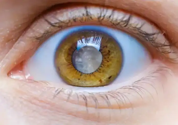 Καταρράκτης: 7 συμβουλές για να προστατεύσετε τα μάτια σας