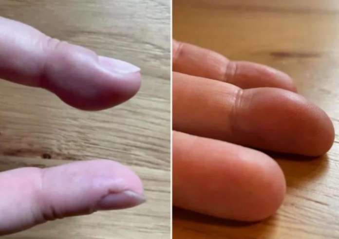 Γυναίκα ξύπνησε και είδε το δάκτυλό της να έχει γίνει τεράστιο – Η ασυνήθιστη διάγνωση των γιατρών