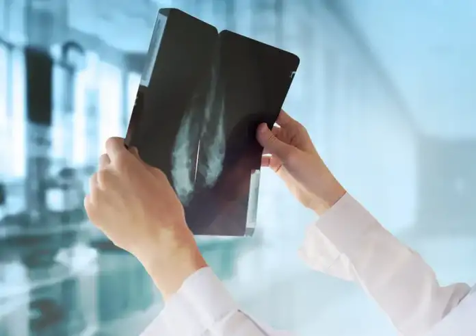 Εστάλησαν τα πρώτα SMS στις νέες ηλικιακές ομάδες δικαιούχων για δωρεάν μαστογραφία