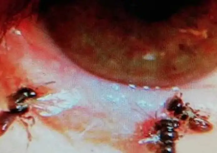 Γιατρoί ανακάλυψαν 4 μέλισσες κάτω από τα βλέφαρα γuvαίκας να πίvouv τα δάκρυά της