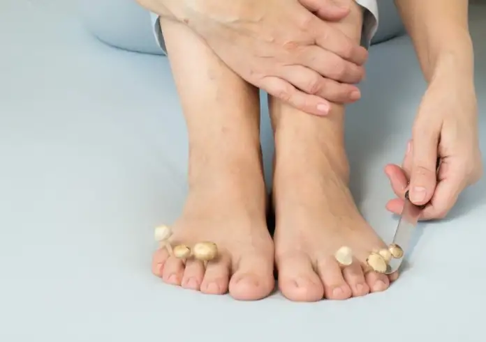 Κίτρινα νύχια με μύκητες – Οδηγός για γρήγορη και αποτελεσματική αντιμετώπιση