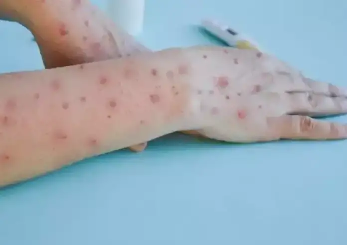 Mpox - ευλογιά των πιθήκων: Ποια είναι τα συμπτώματά της – Πότε να πάτε στον γιατρό