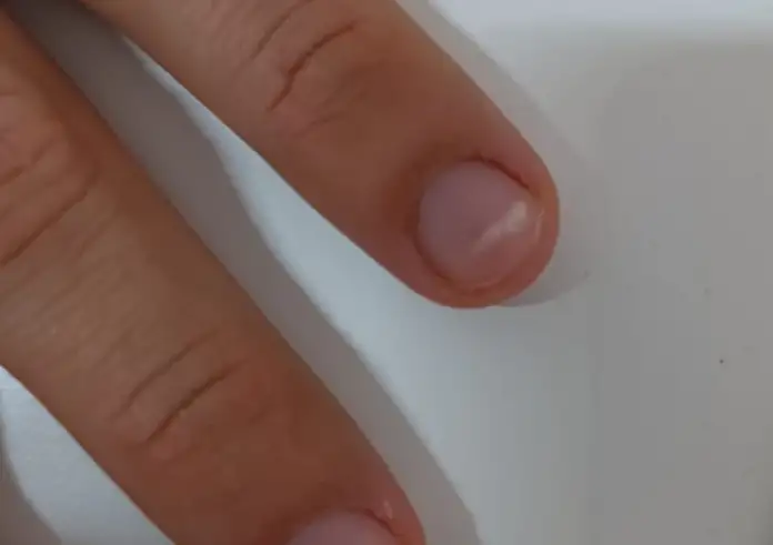 Τι μπορεί να σημαίνουν οι ρίγες των νυχιών