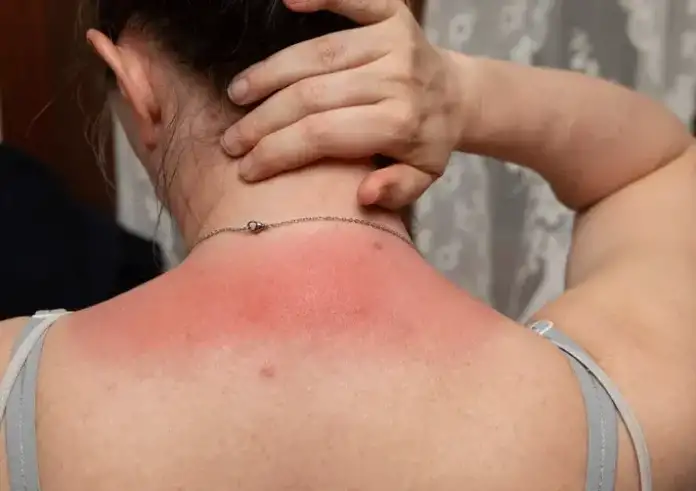 Έρευνα για καρκίνο του δέρματος: Πού εμφανίζεται συχνότερα σε άνδρες και γυναίκες