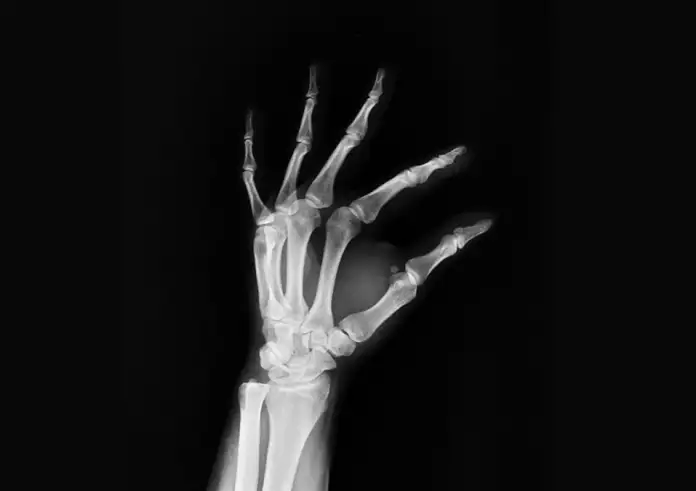 Οστεοπόρωση: Ποιες τροφές «προστατεύουν» τα οστά καθώς μεγαλώνουμε