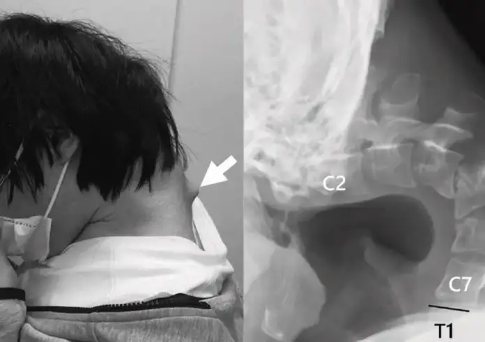 Είμαι πλέον με το κεφάλι συνέχεια σκυμμένο : Πώς η κατάχρηση κινητού παραμόρφωσε τον σκελετό ενός 25χρονου