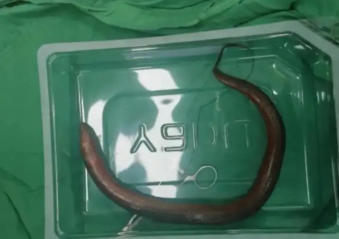 Έβγαλαν ζωντανό χέλι από την κοιλιά άνδρα – Ήταν 30 εκατοστά και «κολυμπούσε» μέσα του