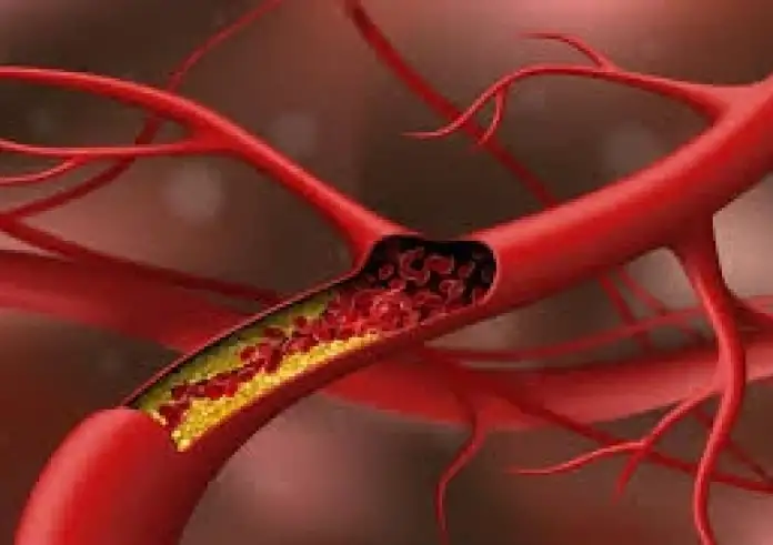 Χοληστερίνη: Πώς να τη ρίξετε χωρίς φάρμακα – Οι 6 συμβουλές που δίνουν οι γιατροί και ένα tip