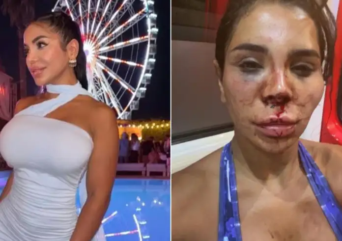 Γαλλία: Στιγμές φρίκης για 30χρονη influencer – Διαρρήκτες την έδεσαν, τη χτύπησαν και την έλουσαν με χλωρίνη