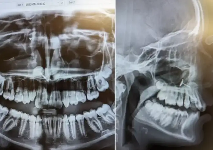 Πήγε την κόρη της για σιδεράκια – Η ακτινογραφία αποκάλυψε ένα μυστικό που έκρυβε για μήνες
