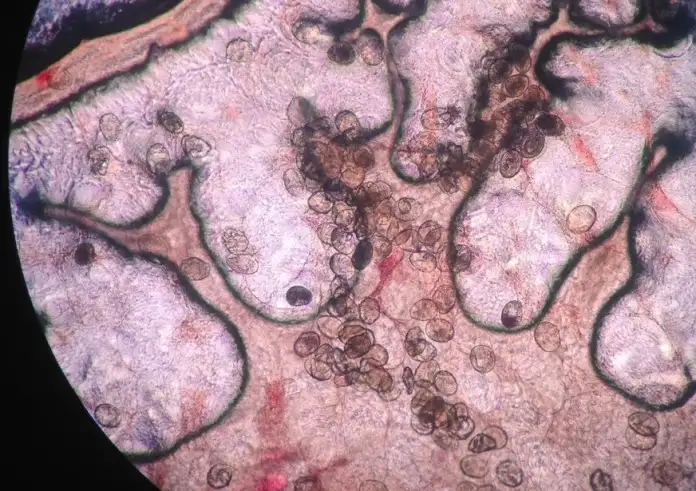 Το παράσιτο που τρυπώνει στο δέρμα χωρίς να το καταλάβετε – και απειλεί χιλιάδες ζωές