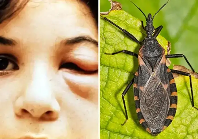 Επιφυλακή στις ΗΠΑ για τα «ακάρεα του φιλιού»: Μεταδίδουν τη νόσο Τσάγκας που μπορεί να αποβεί θανατηφόρα