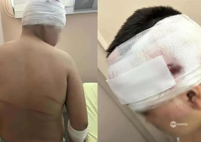 Θεσσαλονίκη: Έντεκα άτομα επιτέθηκαν με ξύλα και σιδερόβεργες σε 13χρονο – Παραμένει στο νοσοκομείο