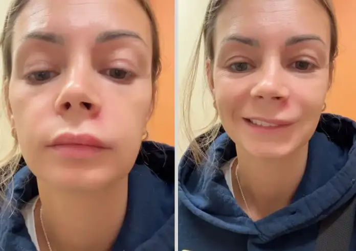 Γυναίκα κατέληξε στα επείγοντα όταν «έσπασε» το σπυρί της – Το λάθος που έκανε και παρέλυσε το πρόσωπό της