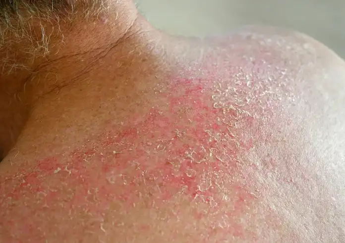 Επιστροφή της λέπρας στη Ρουμανία μετά από 44 χρόνια: Συναγερμός σε σπα με δύο μασέζ – Λουκέτο από τις αρχές