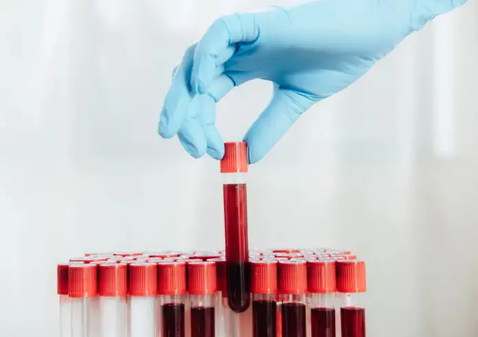 Νόσος του Crohn: Η απλή εξέταση αίματος που «προδίδει» την πάθηση χρόνια πριν τα συμπτώματα