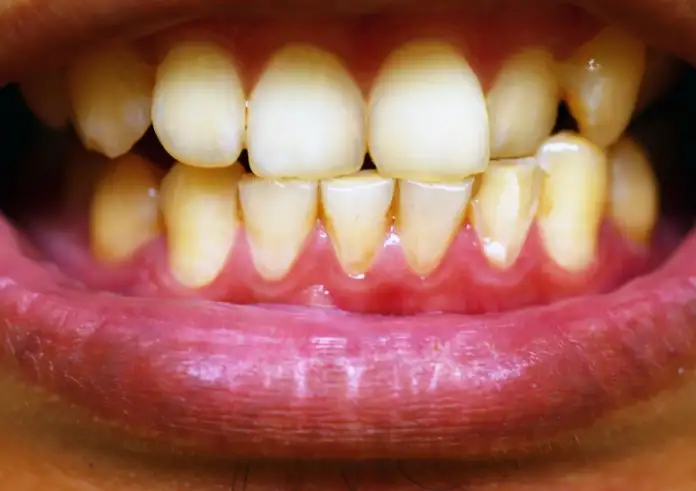 Προσοχή: Τι αποκαλύπτει η ουλίτιδα για την καρδιά σας – Η σύνδεση «σοκ» με εγκεφαλικά και εμφράγματα