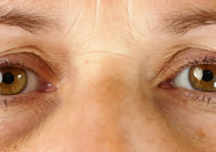 Το σημάδι στο πρόσωπο που «προδίδει» την άνοια: Τι αποκαλύπτει το «πόδι της χήνας» για την υγεία του εγκεφάλου