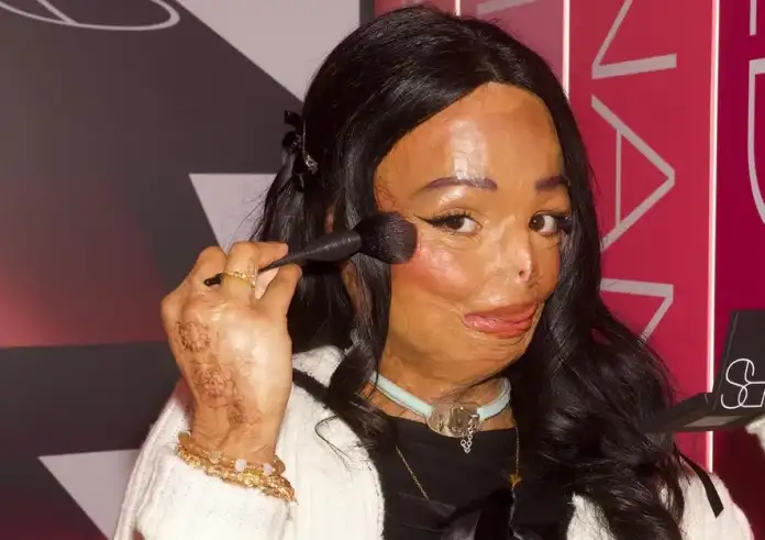 Τρόμος στο σπίτι: 12χρονη τυλίχθηκε στις φλόγες από σαμπουάν για ψείρες – Η συγκλονιστική μάχη της να «ξαναγεννηθεί»