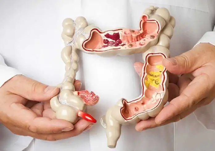 Συναγερμός για τον καρκίνο του παχέος εντέρου: Αυξάνονται ραγδαία τα κρούσματα σε άτομα κάτω των 50 ετών