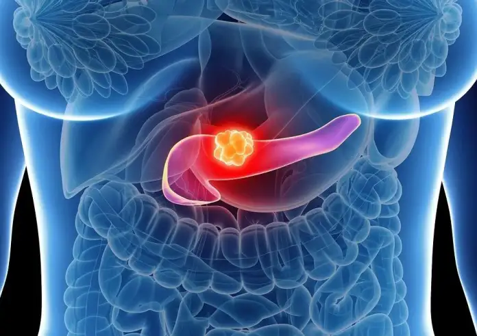 Καρκίνος παγκρέατος: Το «αθόρυβο» σημάδι που εμφανίζεται 3 χρόνια πριν τη διάγνωση