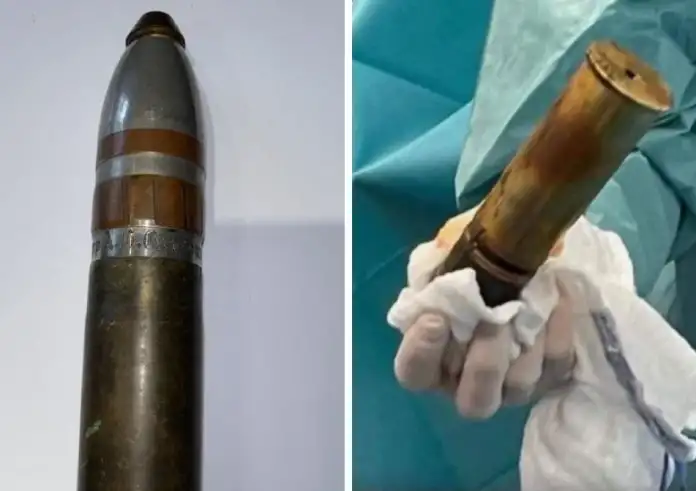 Συναγερμός σε νοσοκομείο: Πυροτεχνουργοί στα Επείγοντα για ενεργό βλήμα του 1918 σφηνωμένο σε ασθενή