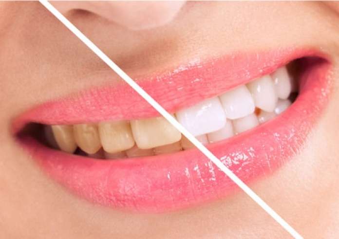 Λεύκανση δοντιών: 3 τρόποι να την κάνετε φυσικά στο σπίτι
