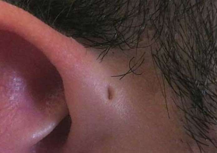 Τα 7 πιο απίθανα πράγματα που έχουν βρει οι γιατροί μέσα σε αυτιά ασθενών