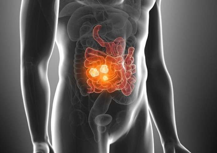 Καρκίνος παχέος εντέρου: Εάν τρώτε αυτή την ώρα αυξάνετε σημαντικά τον κίνδυνο