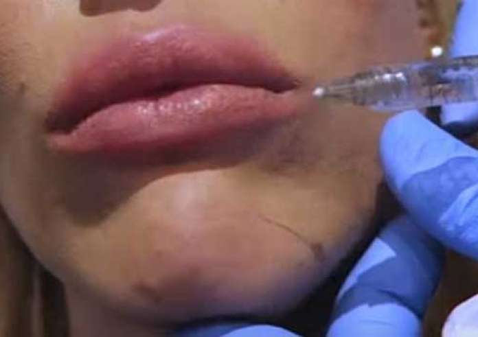 Μας έχουν καταστρέψει οι Καρντάσιαν; - Πόσο υγιές είναι να κάνουν οι έφηβοι fillers;