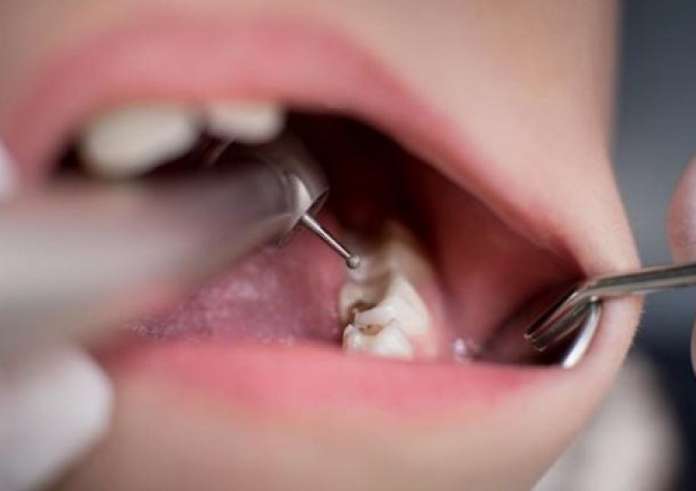 Οδοντίατρος αφαιρεί το το μακρύτερο δόντι που έχει βρεθεί ποτέ σε άνθρωπο