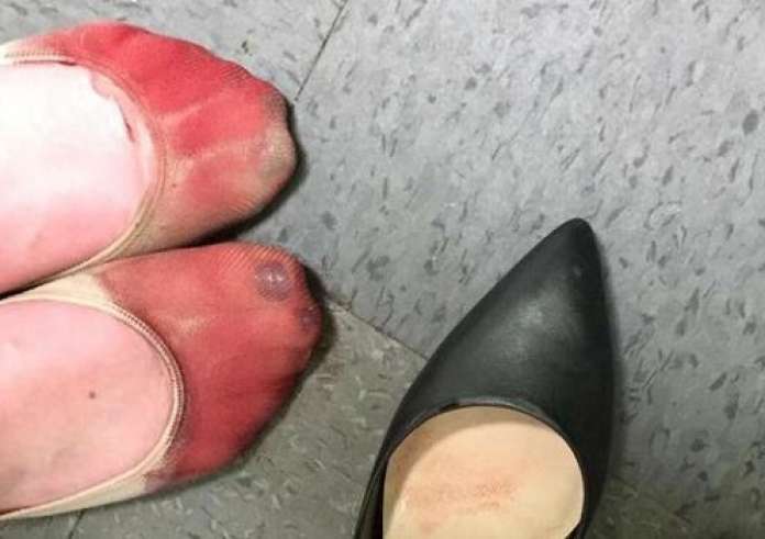Τα καταματωμένα πόδια μιας σερβιτόρας από τα τακούνια στην πιο viral φωτογραφία