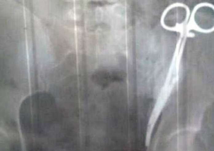 Είχε για 23 χρόνια ξεχασμένο στην κοιλιά της ένα χειρουργικό ψαλίδι