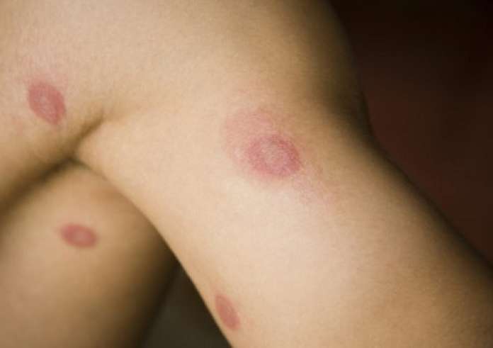 Αύξηση της ευλογιάς των πιθήκων: Το νέο στέλεχος του ιού σημάνει συναγερμό στις παγκόσμιες υγειονομικές αρχές