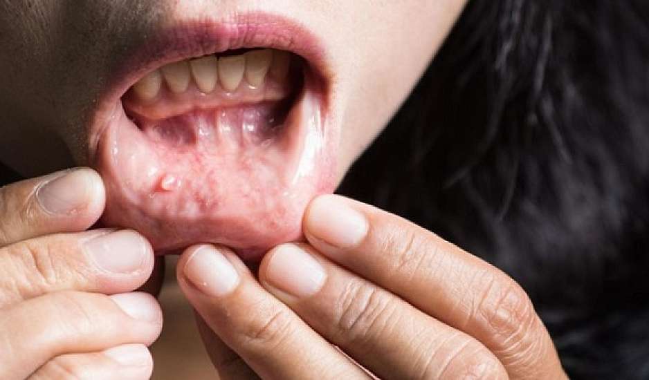 Άφθες - άφτρες στο στόμα: Αίτια, συμπτώματα και αντιμετώπιση