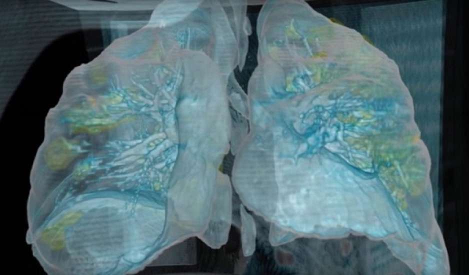 Κορονοϊός: Βίντεο δείχνει τη ζημιά που προκάλεσε ο κορονοϊός στους πνεύμονες ασθενούς