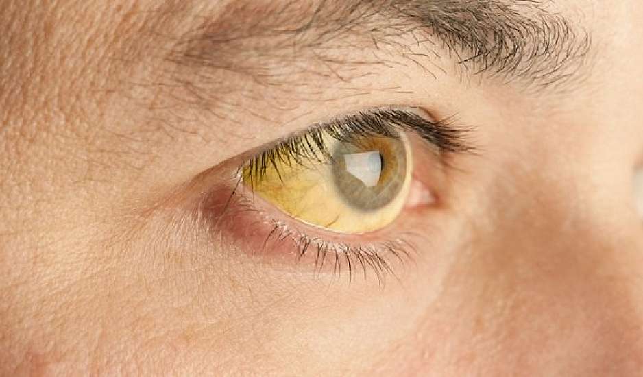 Ποιο πρόβλημα υγείας φανερώνουν τα κίτρινα μάτια