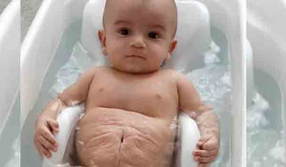 Αγοράκι γεννήθηκε χωρίς κοιλιακούς μύες