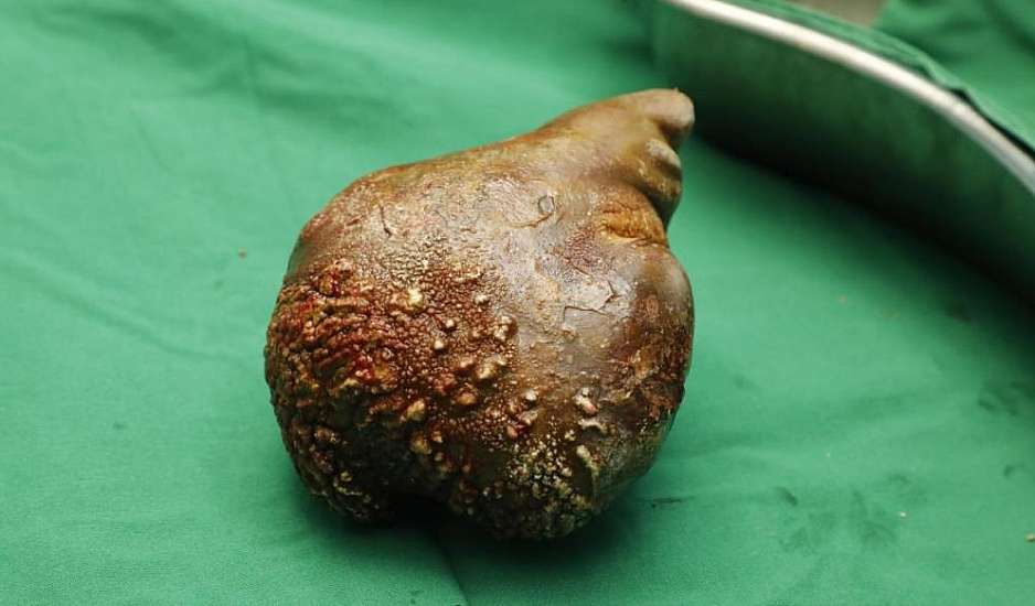 Αφαίρεσαν πέτρα από τα νεφρά βάρους 800 γραμμαρίων - Η μεγαλύτερη που έχει καταγραφεί ποτέ