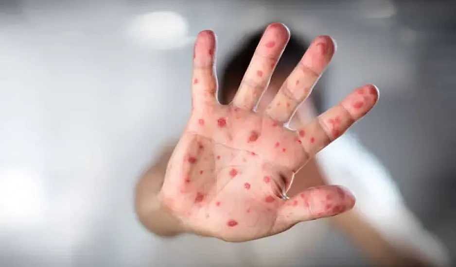 Προειδοποιήσεις για την επανεμφάνιση της ιλαράς: «Τα κρούσματα είναι 45 φορές υψηλότερα»